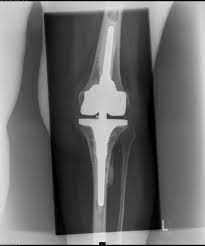 Kniegelenkersatz Orthopadie Wurzburg Kitzingen