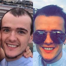 Did my hair transplant work? Of course it did. I'm so happy right now with  how it's growing, with still plenty of thickness to come over the next  coming months! I'm so