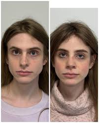 Mardirossian Facial...