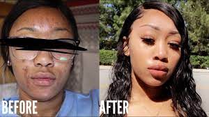 My Skincare Routine How I Cleared My Acne Dark Spots Skin Care Routine Acne Dark Spots Dark Spots On Skin