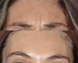 Respiratory failure due to paralysis may require mechanical ventilation for 2 to 8 weeks, plus intensive medical and nursing care. Photos Avant Apres Injections De Botox A Geneve Dr Herve Raspaldo