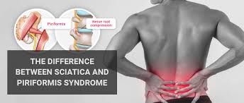 Drive both knees out against the band resistance. Sciatica Or Piriformis The Difference Between Piriformis Syndrome And Sciatica
