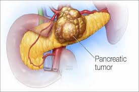 Disparities in incidence and mortality of pancreatic cancer in the world
