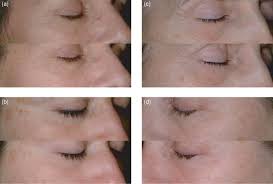 Wrinkle and pigment reduction. (a) wrinkle reduction before and after...