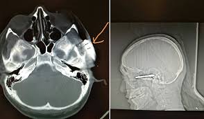 Pilihlah batang kayu untuk anak panah.2 x teliti sumber anak panah harus dibuat dari batang paling lurus yang dapat anda temukan. Pelajar Cedera Di Mata Tertusuk Anak Panah