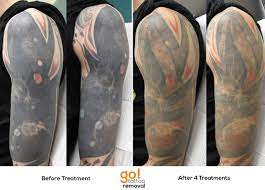 After 4 Laser Tattoo Removal Treatments This Sleeve Is Showing Amazing Results Considering It S Multiple Cove Tattoo Removal Laser Tattoo Laser Tattoo Removal