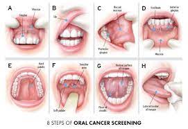 What are the symptoms of oral cancer? Oral Cancer Screening Identify Cancerous Cells In The Mouth