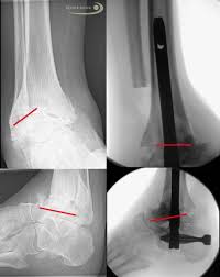 Fusions of the chopart joint, the lisfranc joint, the 1st mpj and the joints of the lesser toes are discussed in this paper. Charcot Marie Tooth Symptome Ursachen Behandlung Gelenk Klinik De
