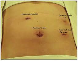 Después de una comida en mal estado y en función del tipo de bacteria el dolor en el abdomen en el lado izquierdo podría empezar después de pasadas de 1 hora a 48 horas. Diagnostico Y Manejo De La Hernia Paraduodenal