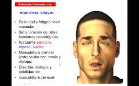 Miastenia Gravis