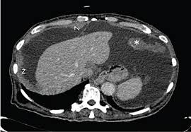 Patients have either a ct scan or mri of the abdomen and pelvis to confirm the presence of new or recurrent disease in the peritoneum. Malignant Peritoneal Mesothelioma In A Clerk A Diagnostic Dilemma Clinmed International Library