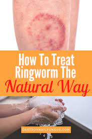 If you have a a really stubborn case of ringworm, then i recommend using tea tree oil as well as oregano oil. How To Treat Ringworm The Natural Way What You Need To Know