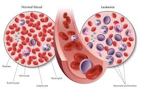 Some general signs and symptoms associated with, but not specific to, cancer, include: Leukaemia Causes Symptoms Treatment Clicks Health Hub