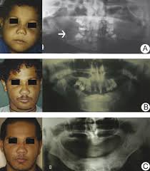 Affected children appear normal at birth. Cherubism Long Term Follow Up Of 2 Patients In Whom It Regressed Without Treatment British Journal Of Oral And Maxillofacial Surgery