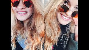 My Full Jaw Surgery Story 2016