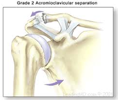 Partial microscopic tearing of the ligament, minimal to no loss of function, mild swelling and pain. Ac Separation