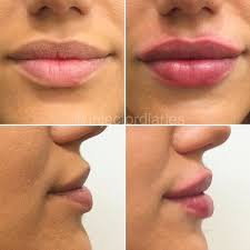 Pin On Filler