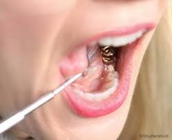 Maybe you would like to learn more about one of these? Gold Teeth Dentist In Slidell La