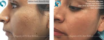 Laser treatment cannot get rid of a scar. Acne Scar Treatments Nyc Scar Reduction By Dr Ron Shelton