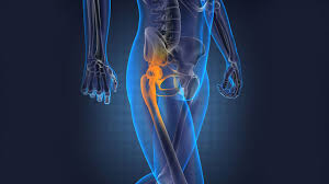 It's unclear what causes bone cancer, but medical professionals have actually discovered certain elements are connected with an increased danger, consisting of Metastatic Bone Cancer Symptoms Our Deer