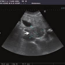 Liver cancer is the growth and spread of unhealthy cells in the liver. Abdominal Ultrasound Demonstrating A Liver Tumor Of Size 5 9 A 5 7 Cm Download Scientific Diagram