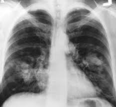 Pleural mesothelioma — the most common of the four types — had an incidence rate of 3.05 cases per 100,000 people, according to a 2013 study . Mesothelioma Epidemiology And Prognosis