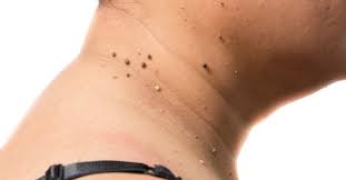 8 Formas Naturales Para Quitar Las Verrugas Del Cuello En 2020 Como Quitar Verrugas Verrugas Remedios Para Verrugas