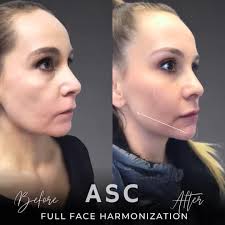 Full Face Harmonization-Swipe for the transformation! Our client came in  with concerns about a downturned smile, small chin, under-eye bags, lost  volume in the cheeks, and softened facial contours. Through a carefully