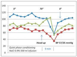 Image result for Exercise Induced Syncope