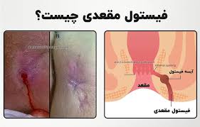 فیستول مقعدی چگونه به وجود می آید؟
