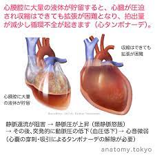 湿性心膜炎などで心膜腔に大量の液体が貯留すると 心臓が圧迫され収縮はできても拡張が困難となり 拍出量が減少し循環不全が起きることを という 解答 心タンポナーデ 湿性心膜炎などで心膜腔に大量の液体が貯留すると 心臓が圧迫され収縮はできても拡張