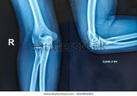 Image result for Elbow XRay