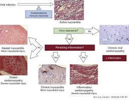 Journal of the american college of cardiology vol. Update On Myocarditis And Inflammatory Cardiomyopathy Reemergence Of Endomyocardial Biopsy Revista Espanola De Cardiologia