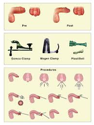 Image result for circumcision shield