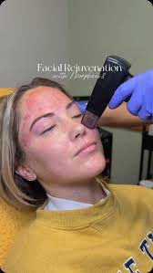Ready to rejuvenate your skin? Discover the power of Morpheus 8! 🌟 This  cutting-edge procedure combines microneedling with radiofrequency to  tighten, lift, and contour your skin. Say goodbye to ...