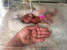 Desarrollo de un embarazo de 22 semanas. Bebe Prematuro De 22 Semanas Luta Pela Sobrevivencia Prematuridade Com Associacao Brasileira De Pais Familiares Amigos E Cuidadores De Bebes Prematuros