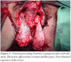 Fournier gangrene was first identified in 1883, when the french venereologist jean alfred fournier described a series in which 5 previously healthy young men suffered from a rapidly progressive. Scielo Brasil Relation Between The Area Affected By Fournier S Gangrene And The Type Of Reconstructive Surgery Used A Study With 80 Patients Relation Between The Area Affected By Fournier S Gangrene