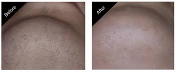 23 10 steps to take before using your hair removal machine. Laser Hair Removal Carmel Body Hair Removal The New You Esthetics