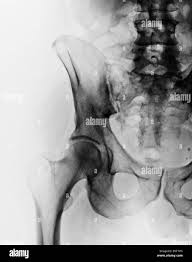 Image result for Hip XRay