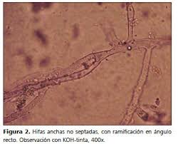 Pía spalloni m, patricia glaser k, patricia verdugo l. Mucormicosis Cutanea En Un Paciente Inmunocomprometido