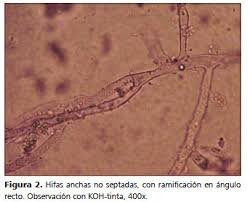 These molds live throughout the environment. Mucormicosis Cutanea En Un Paciente Inmunocomprometido