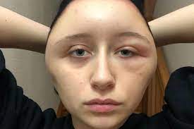A vegan health and fitness vlogger has shared pictures of the horrific allergic reaction she had to henna hair. Woman S Head Doubles In Size After Horrific Allergic Reaction To Common Hair Dye World News Mirror Online