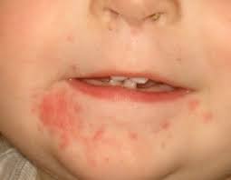 Teething Rash Face Pictures Teething Rash On Face Rash On Face Teething Rash