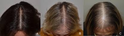 However, it is estimated that more than 50% of women will experience noticeable hair loss. Female Androgenetic Alopecia An Update On Diagnosis And Management Springerlink