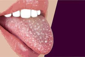 Image result for cancer of tongue