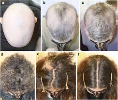 Hair loss treatment treating alopecia areata hair transplant what you can do. Successful Treatment Of Long Standing At In A 43 Year Old Female With Download Scientific Diagram