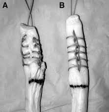 Hong, ck., lin, cl., yang, jm. Krackow Locking Stitch Versus Locking Premanufactured Loop Stitch For Soft Tissue Fixation A Biomechanical Study Arthroscopy