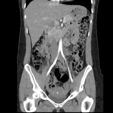 Image result for Helical CT Urogram