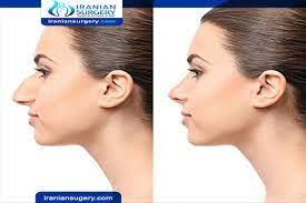 How much is it to get a nose job. Rhinoplasty In Iran 6 Best Rhinoplasty Surgeons Nose Job Iranian Surgery