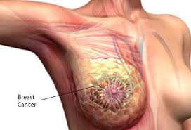 Part of or all of the breast may be swollen, enlarged, and hard. Breast Cancer Definition Causes Prevention Stages Symptoms